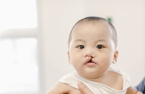 child with a cleft lip