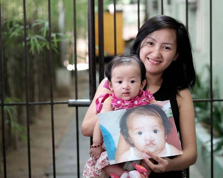 mom holds child after cleft surgery